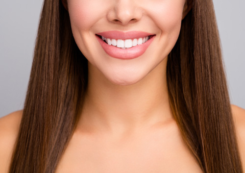 ideal veneers